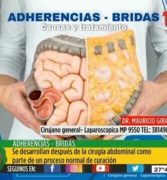 ¿Qué es una brida?