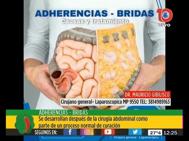 ¿Qué es una brida?